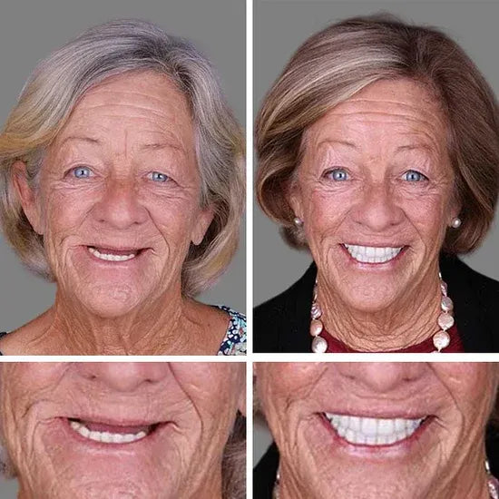 Custom-Fit Instant Smile Dentures – Natural Looking Comfort Fit